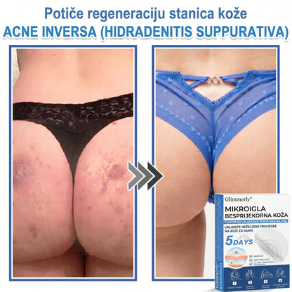 👩‍⚕️ Glimmerly® 2 u 1 MIKROIGLA BESPRIJEKORNA KOŽA | Sredstvo za uklanjanje podignutih madeža, akni, ravnih bradavica i kožnih izraslina | Poboljšava bore, ožiljke i mrlje | Nevidljivi flasteri za prištiće za lice i tijelo | 144 komada