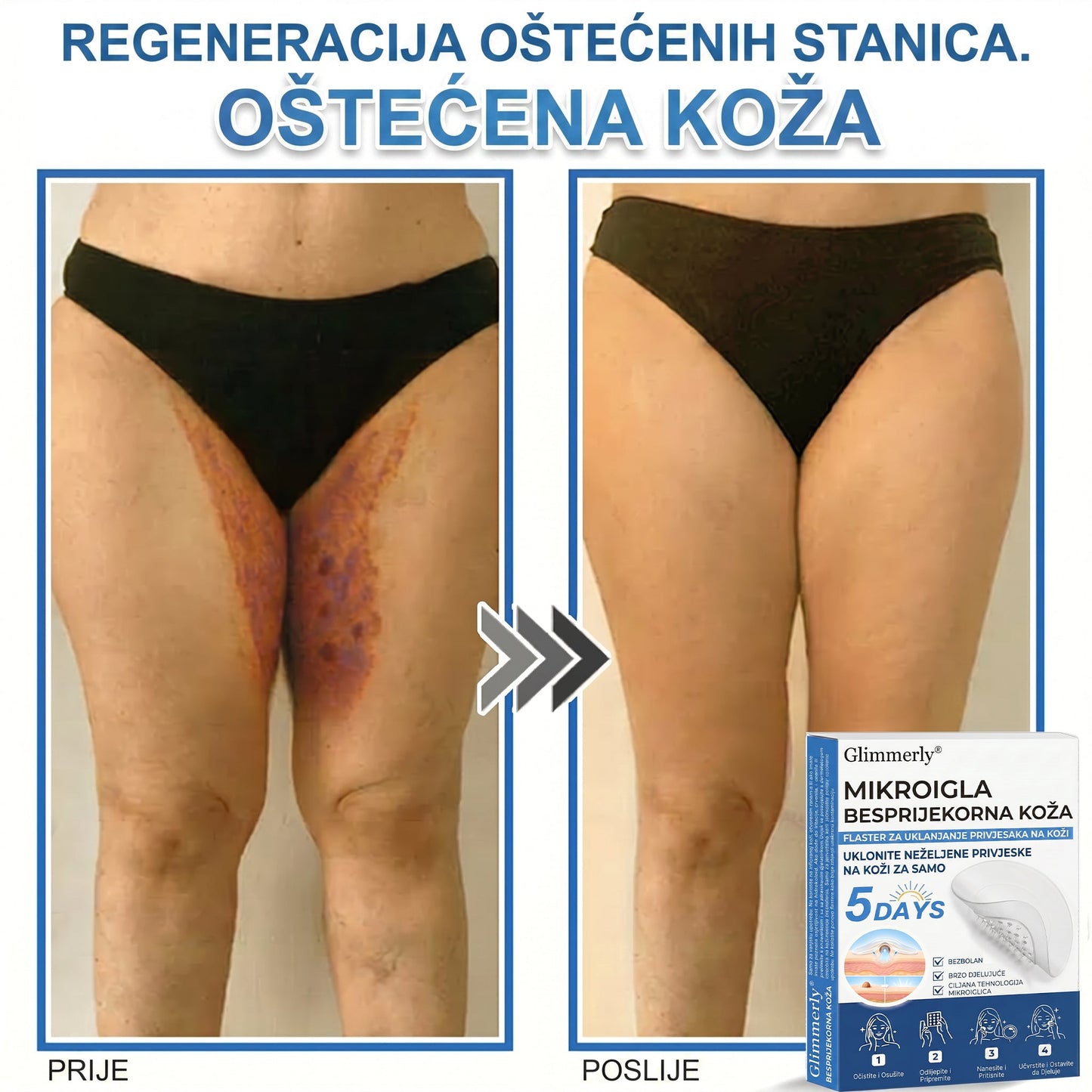 👩‍⚕️ Glimmerly® 2 u 1 MIKROIGLA BESPRIJEKORNA KOŽA | Sredstvo za uklanjanje podignutih madeža, akni, ravnih bradavica i kožnih izraslina | Poboljšava bore, ožiljke i mrlje | Nevidljivi flasteri za prištiće za lice i tijelo | 144 komada