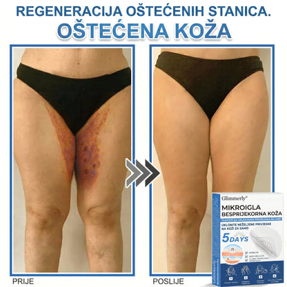 👩‍⚕️ Glimmerly® 2 u 1 MIKROIGLA BESPRIJEKORNA KOŽA | Sredstvo za uklanjanje podignutih madeža, akni, ravnih bradavica i kožnih izraslina | Poboljšava bore, ožiljke i mrlje | Nevidljivi flasteri za prištiće za lice i tijelo | 144 komada