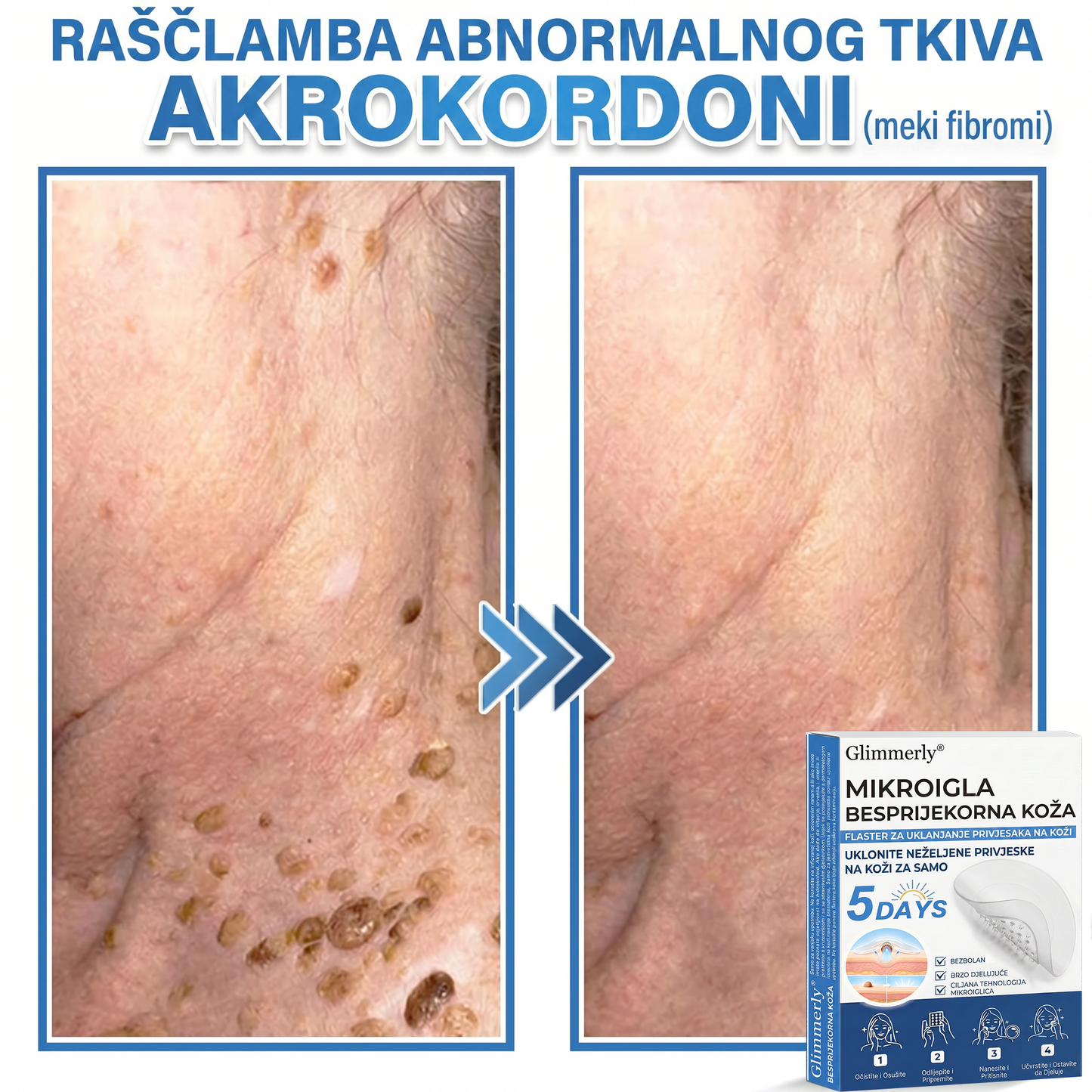 👩‍⚕️ Glimmerly® 2 u 1 MIKROIGLA BESPRIJEKORNA KOŽA | Sredstvo za uklanjanje podignutih madeža, akni, ravnih bradavica i kožnih izraslina | Poboljšava bore, ožiljke i mrlje | Nevidljivi flasteri za prištiće za lice i tijelo | 144 komada
