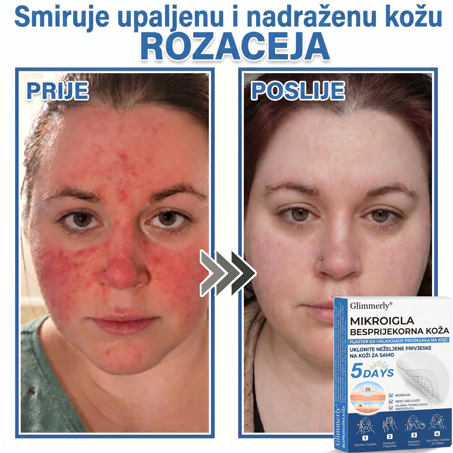 👩‍⚕️ Glimmerly® 2 u 1 MIKROIGLA BESPRIJEKORNA KOŽA | Sredstvo za uklanjanje podignutih madeža, akni, ravnih bradavica i kožnih izraslina | Poboljšava bore, ožiljke i mrlje | Nevidljivi flasteri za prištiće za lice i tijelo | 144 komada
