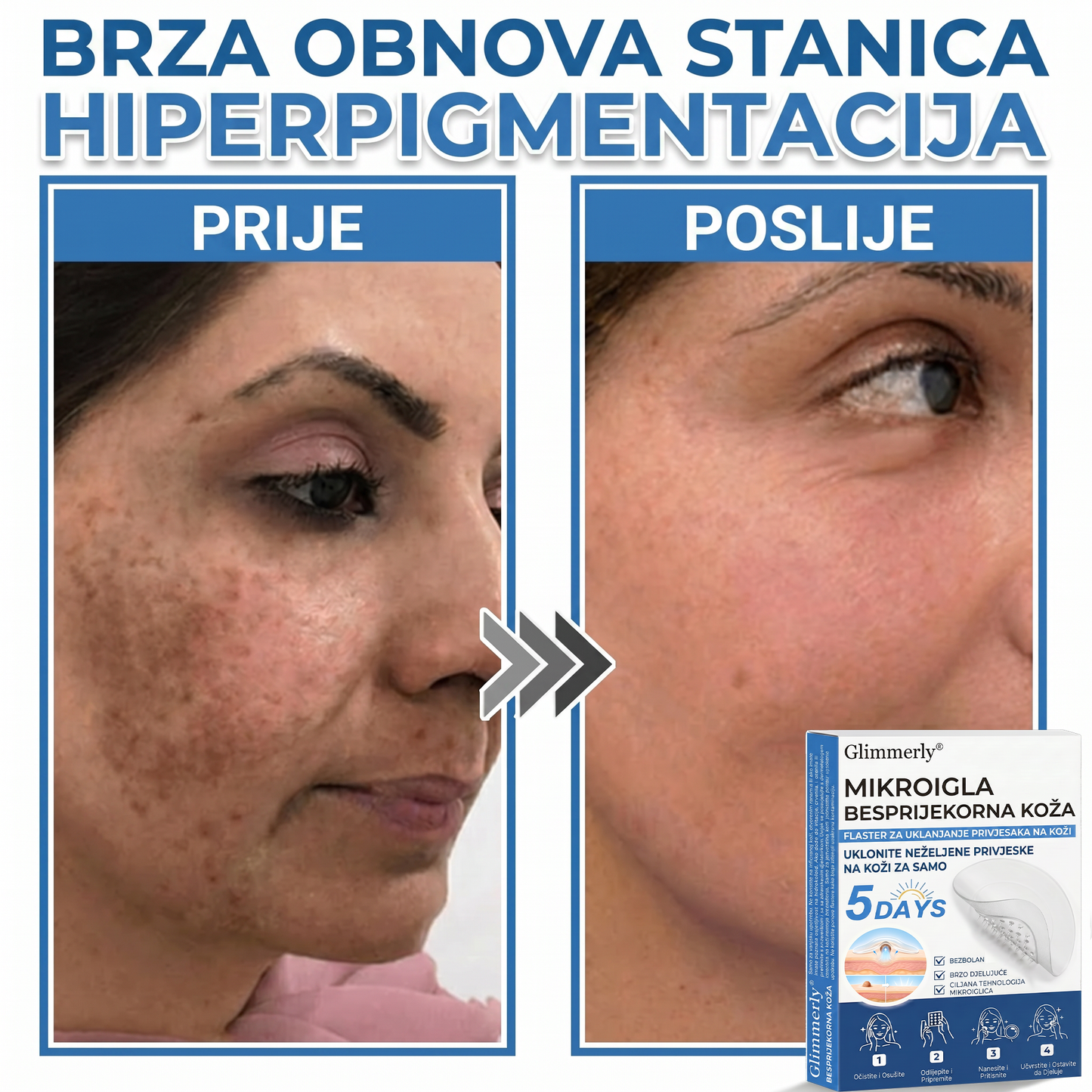 👩‍⚕️ Glimmerly® 2 u 1 MIKROIGLA BESPRIJEKORNA KOŽA | Sredstvo za uklanjanje podignutih madeža, akni, ravnih bradavica i kožnih izraslina | Poboljšava bore, ožiljke i mrlje | Nevidljivi flasteri za prištiće za lice i tijelo | 144 komada