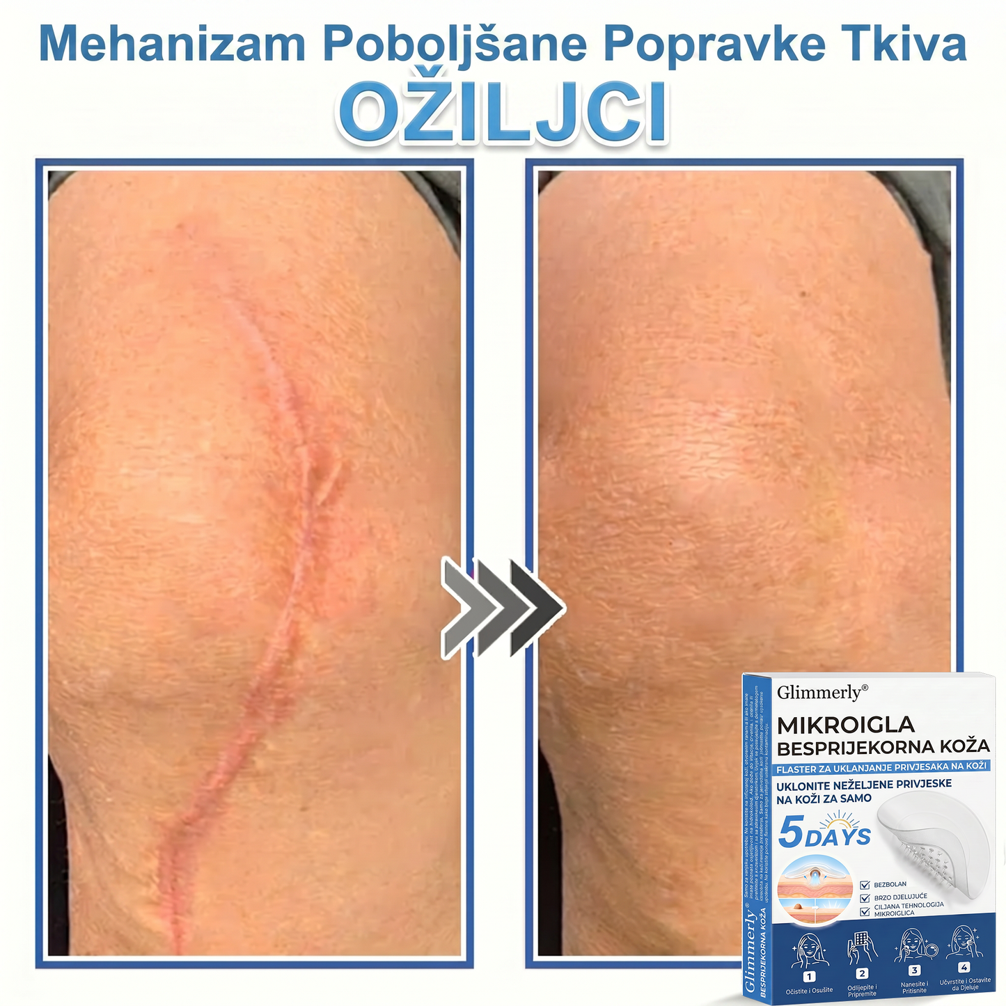 👩‍⚕️ Glimmerly® 2 u 1 MIKROIGLA BESPRIJEKORNA KOŽA | Sredstvo za uklanjanje podignutih madeža, akni, ravnih bradavica i kožnih izraslina | Poboljšava bore, ožiljke i mrlje | Nevidljivi flasteri za prištiće za lice i tijelo | 144 komada