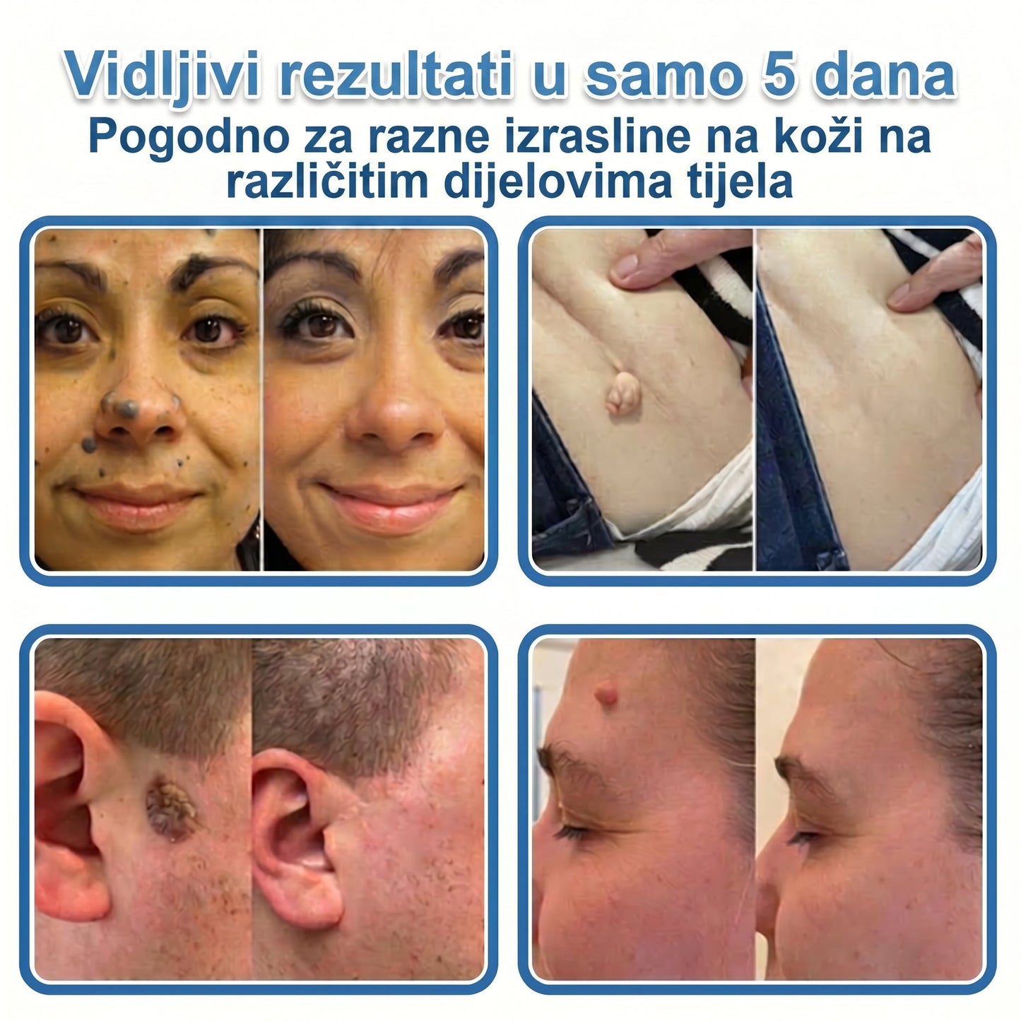 👩‍⚕️ Glimmerly® 2 u 1 MIKROIGLA BESPRIJEKORNA KOŽA | Sredstvo za uklanjanje podignutih madeža, akni, ravnih bradavica i kožnih izraslina | Poboljšava bore, ožiljke i mrlje | Nevidljivi flasteri za prištiće za lice i tijelo | 144 komada