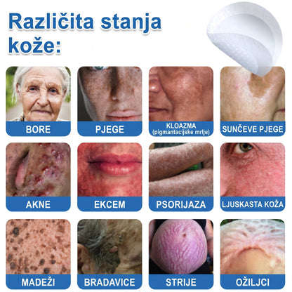 👩‍⚕️ Glimmerly® 2 u 1 MIKROIGLA BESPRIJEKORNA KOŽA | Sredstvo za uklanjanje podignutih madeža, akni, ravnih bradavica i kožnih izraslina | Poboljšava bore, ožiljke i mrlje | Nevidljivi flasteri za prištiće za lice i tijelo | 144 komada
