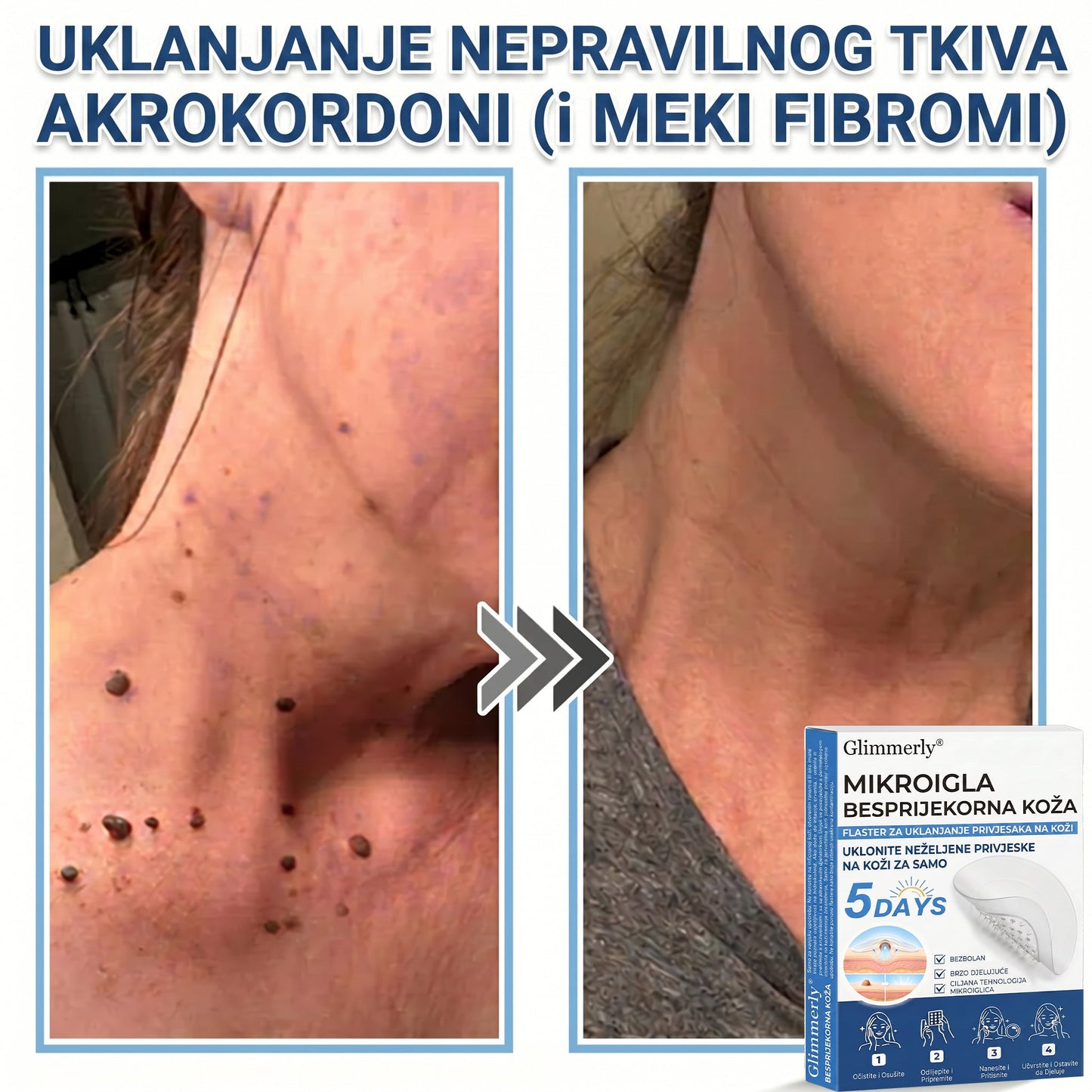 👩‍⚕️ Glimmerly® 2 u 1 MIKROIGLA BESPRIJEKORNA KOŽA | Sredstvo za uklanjanje podignutih madeža, akni, ravnih bradavica i kožnih izraslina | Poboljšava bore, ožiljke i mrlje | Nevidljivi flasteri za prištiće za lice i tijelo | 144 komada