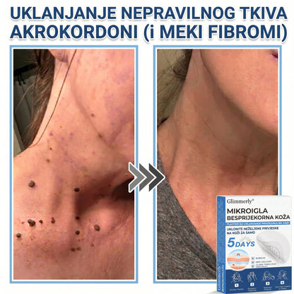 👩‍⚕️ Glimmerly® 2 u 1 MIKROIGLA BESPRIJEKORNA KOŽA | Sredstvo za uklanjanje podignutih madeža, akni, ravnih bradavica i kožnih izraslina | Poboljšava bore, ožiljke i mrlje | Nevidljivi flasteri za prištiće za lice i tijelo | 144 komada