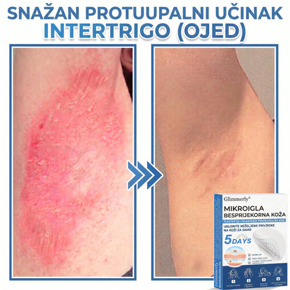 👩‍⚕️ Glimmerly® 2 u 1 MIKROIGLA BESPRIJEKORNA KOŽA | Sredstvo za uklanjanje podignutih madeža, akni, ravnih bradavica i kožnih izraslina | Poboljšava bore, ožiljke i mrlje | Nevidljivi flasteri za prištiće za lice i tijelo | 144 komada
