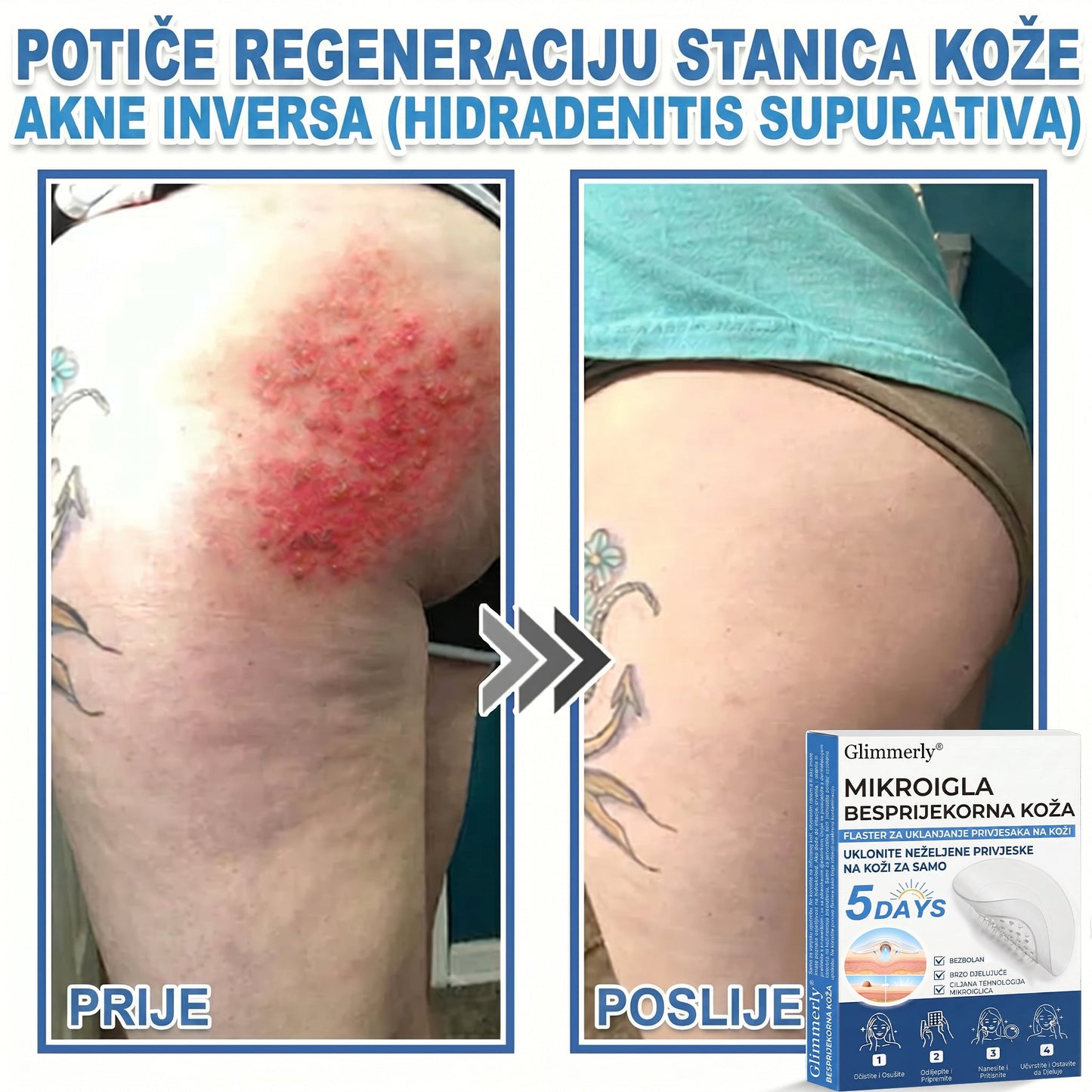 👩‍⚕️ Glimmerly® 2 u 1 MIKROIGLA BESPRIJEKORNA KOŽA | Sredstvo za uklanjanje podignutih madeža, akni, ravnih bradavica i kožnih izraslina | Poboljšava bore, ožiljke i mrlje | Nevidljivi flasteri za prištiće za lice i tijelo | 144 komada