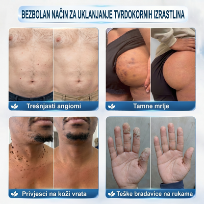 🍀🍀𝐏i𝐜𝐝o® 𝟕-𝐝𝐧𝐞𝐯𝐧𝐢 𝐨𝐝𝐬𝐭𝐫𝐚𝐧𝐣𝐢𝐯𝐚č 𝐛𝐫𝐚𝐝𝐚𝐯𝐢𝐜𝐚 𝐢 𝐦𝐫𝐥𝐢𝐚 (Rollerball bez boli, bez ožiljaka)